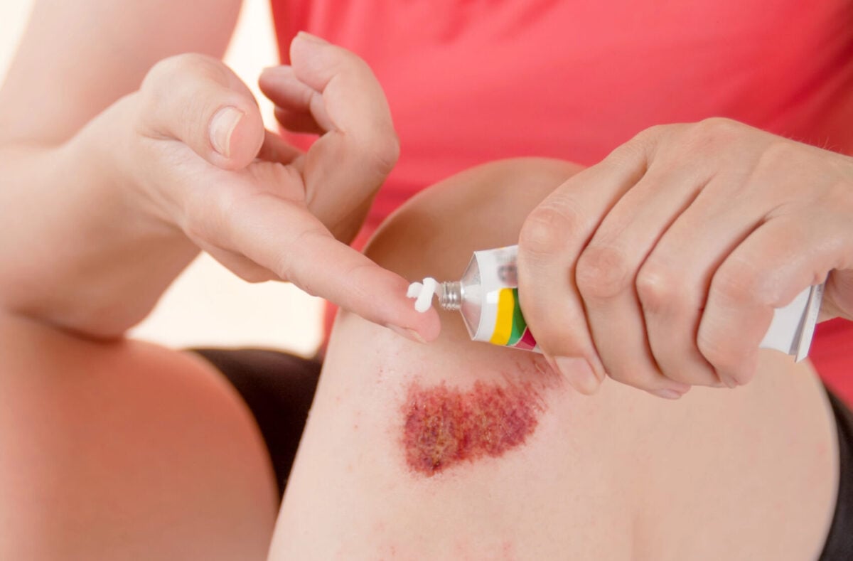 Woman smears ointment on skinned knee closeup.