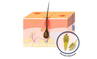 Graphic of close up of dog skin showing what happens with Folliculitis in Dogs