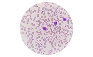 Peripheral blood showing mast cell and two monocyte. Leukocyte with a large round nucleus and numerous dark purple or blue cytoplasmic granules, mast cell.