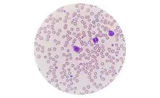Peripheral blood showing mast cell and two monocyte. Leukocyte with a large round nucleus and numerous dark purple or blue cytoplasmic granules, mast cell.